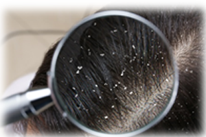Thought pieces_Hair Loss Due to Dandruff– A Common Concern with Siddha Solutions